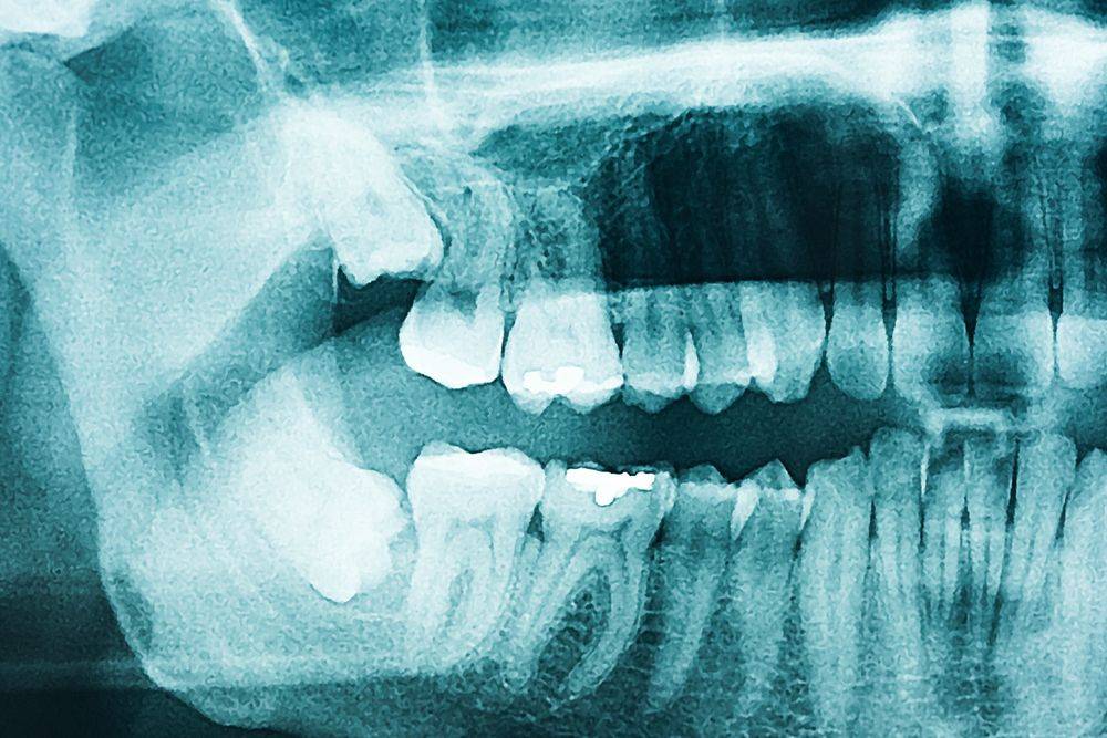 x-ray photograph of wisdom teeth before removal surgery